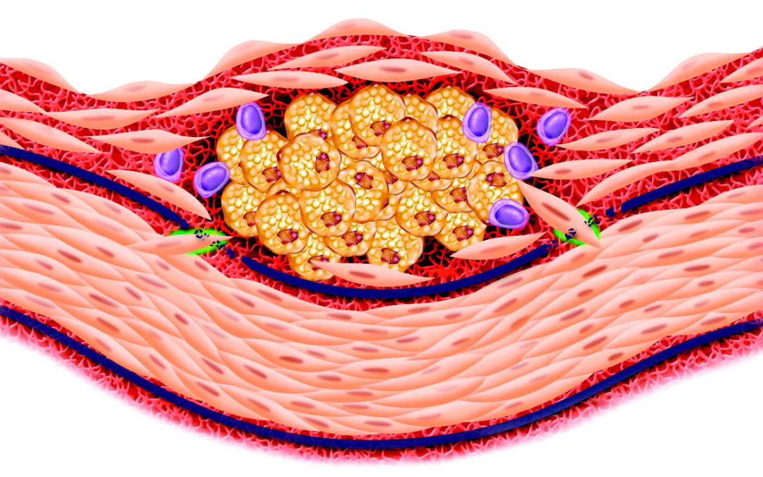 Chronic Stress: A Critical Risk Factor for Atherosclerosis