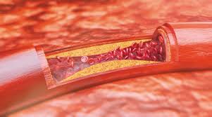 Potential Role of Perivascular Adipose Tissue in Modulating Atherosclerosis