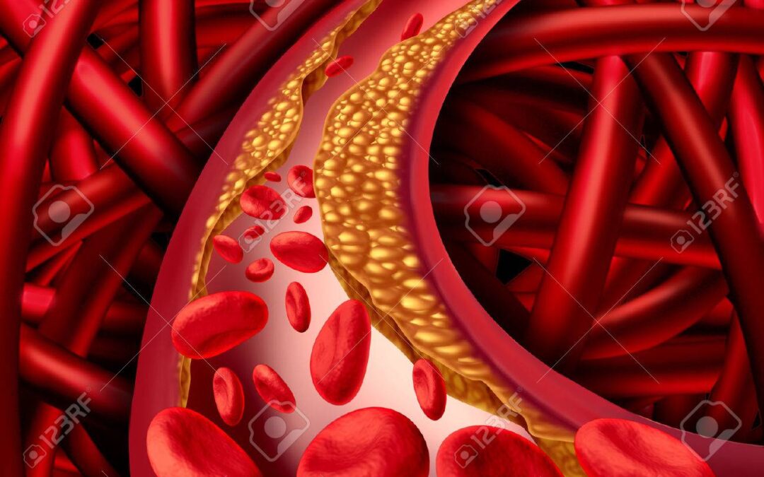 A Plasma Lipid Signature Predicts Incident Coronary Artery Disease
