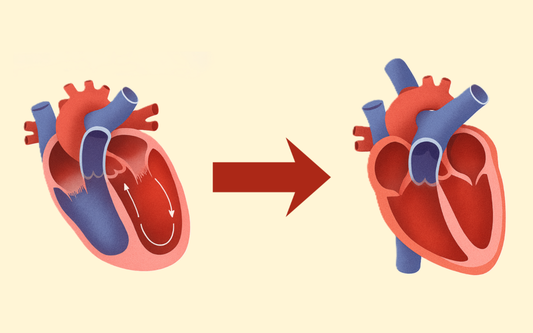 Ivabradine Boosts Reverse Remodeling in Non-Ischemic DCM